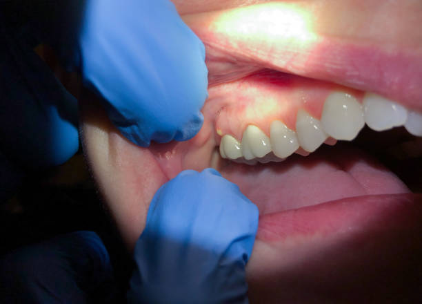 Best Emergency Wisdom Tooth Extraction in Winfield, AL